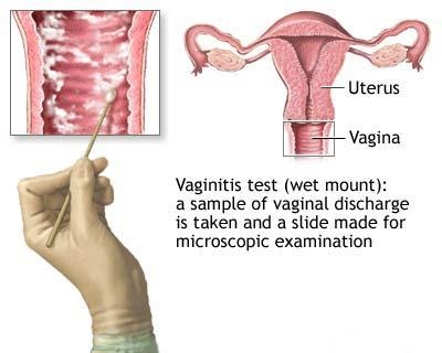 Secretia vaginala